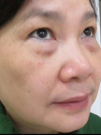 眼袋手术