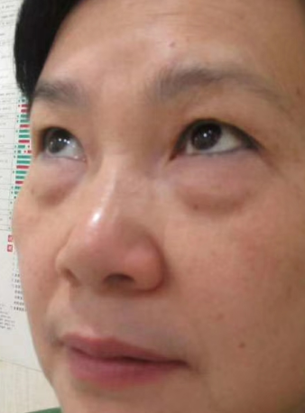 眼袋手术