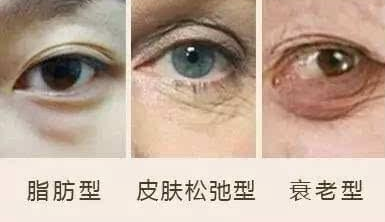 眼袋手术