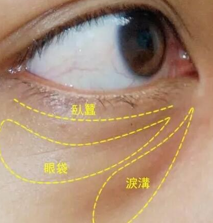 眼袋手术