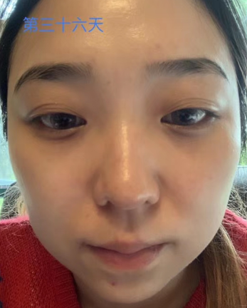 眼袋手术