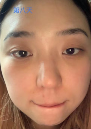 眼袋手术