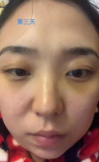 眼袋手术