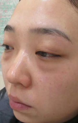 眼袋手术