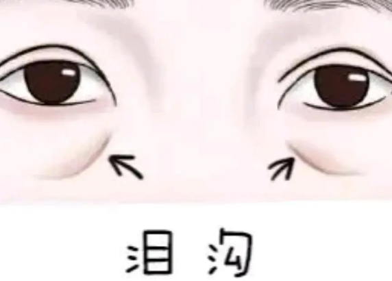 泪沟