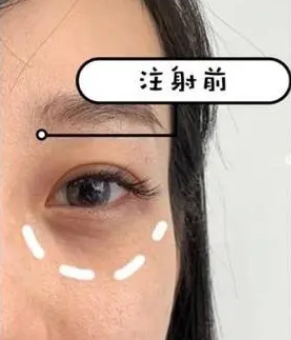 泪沟