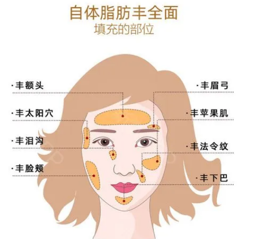 自体脂肪填充