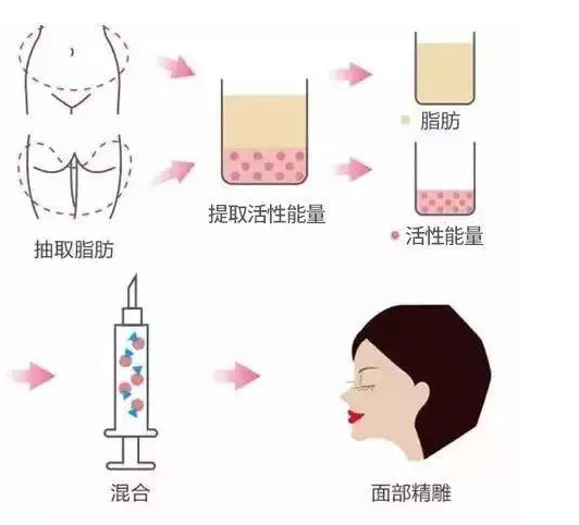 自体脂肪填充