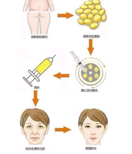 自体脂肪填充