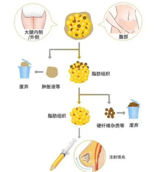 自体脂肪丰胸