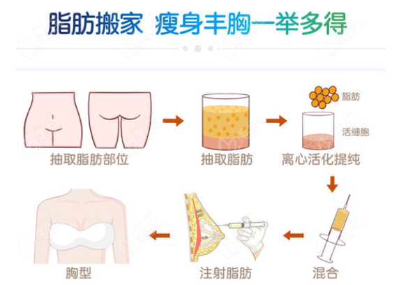 自体脂肪丰胸