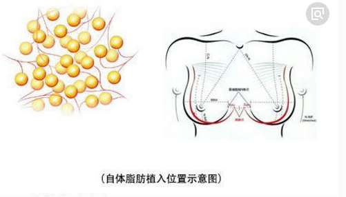 自体脂肪丰胸