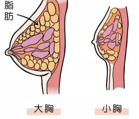 自体脂肪丰胸