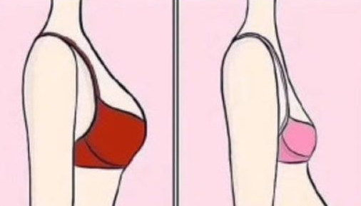 自体脂肪丰胸