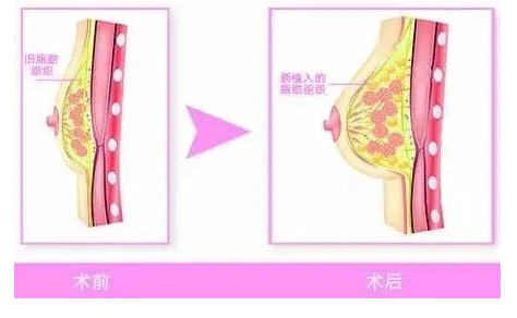 自体脂肪丰胸