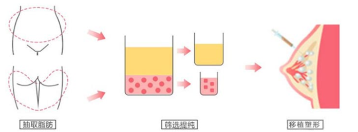 自体脂肪丰胸
