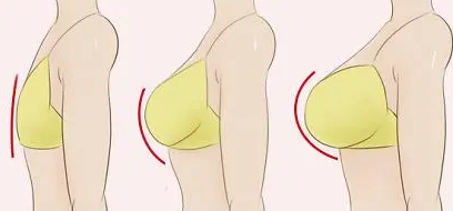 自体脂肪丰胸