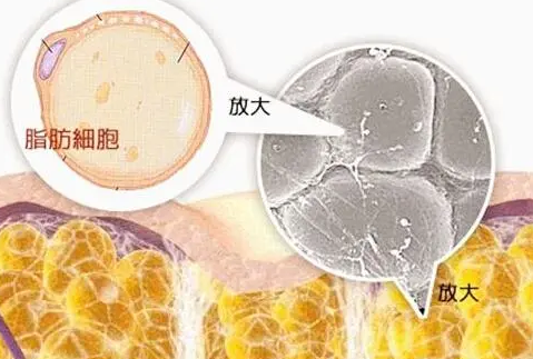 自体脂肪丰胸