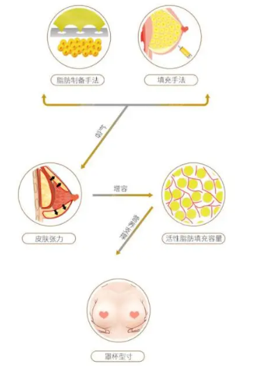自体脂肪丰胸