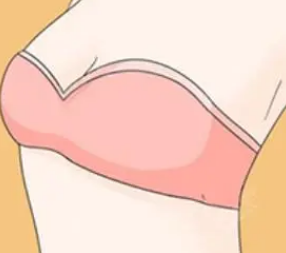 自体脂肪丰胸