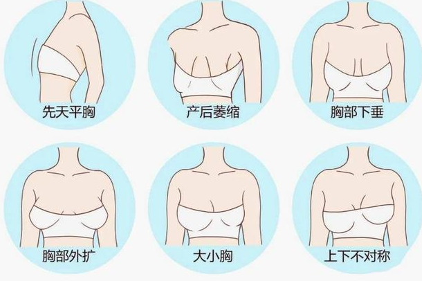 自体脂肪丰胸