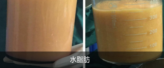 自体脂肪丰胸