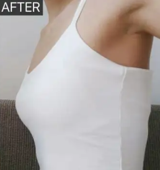 自体脂肪丰胸