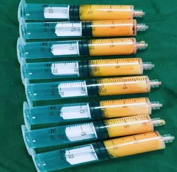 自体脂肪丰胸