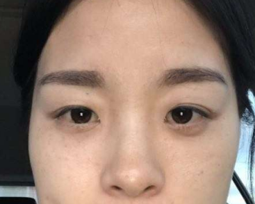 眼袋手术
