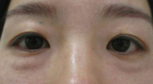 眼袋手术