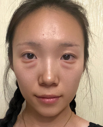 黑眼圈