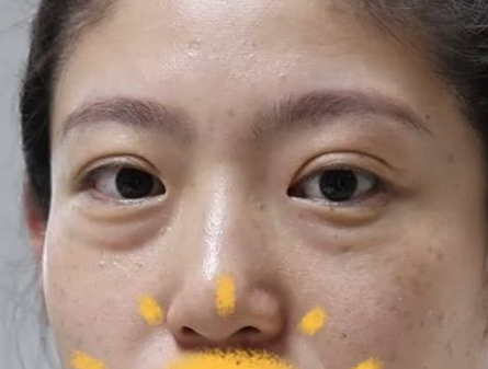 黑眼圈