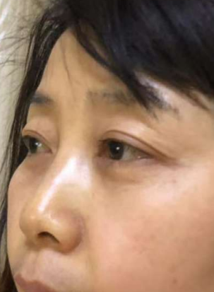 黑眼圈