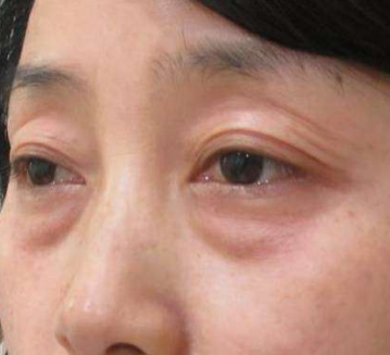 黑眼圈