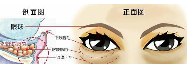 黑眼圈