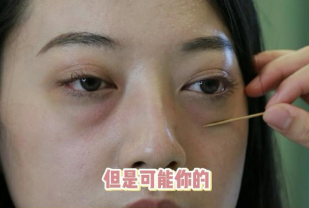 眼袋手术