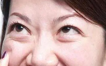 眼袋手术