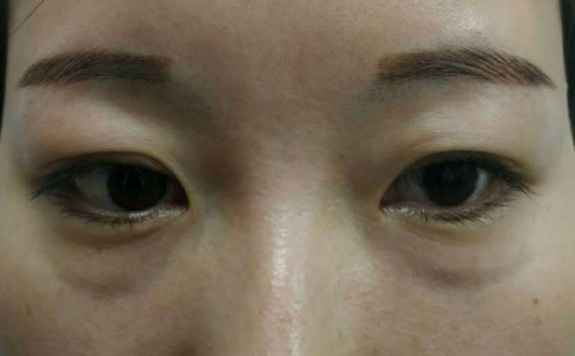 眼袋手术