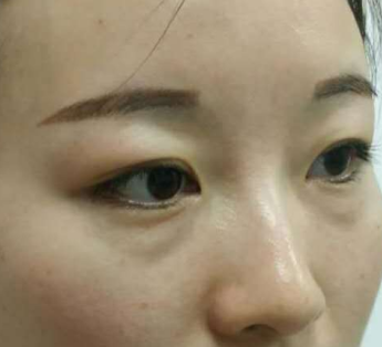 眼袋手术