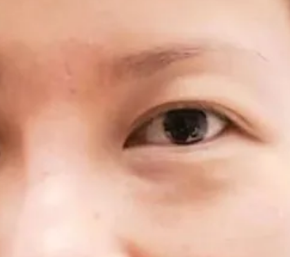 眼袋手术