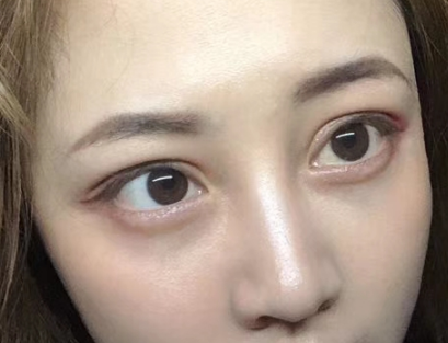眼袋手术
