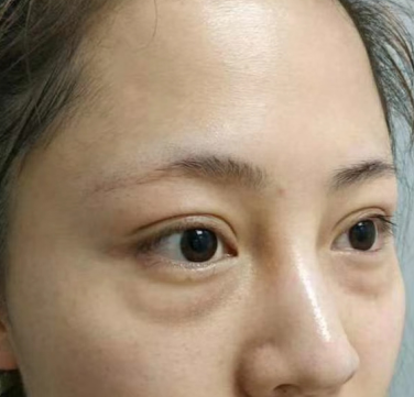 眼袋手术