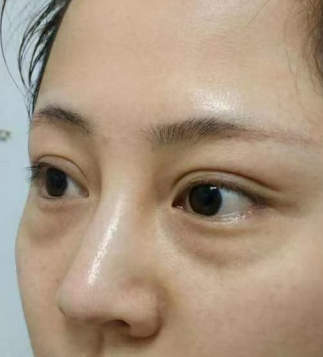 眼袋手术