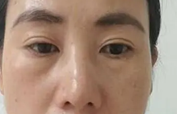 眼袋手术