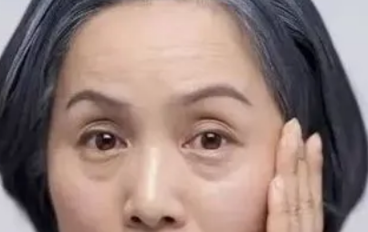 眼袋手术