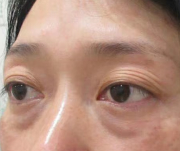 眼袋