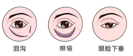 眼袋