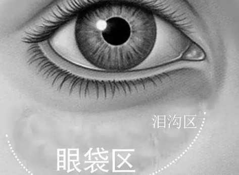 眼袋