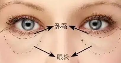 眼袋