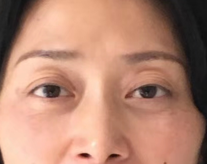 眼袋